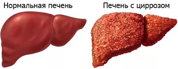 Боль в печени. Симптомы и лечение, как снять народными средствами, лекарствами