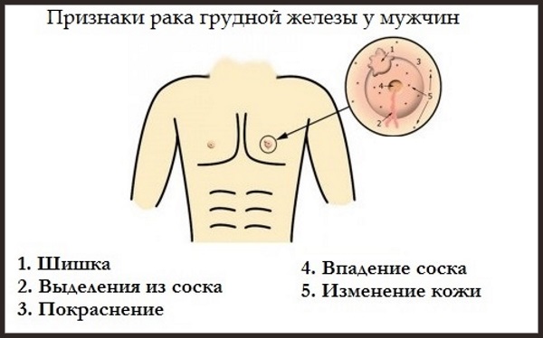 Причины и что делать, если болит грудная железа у мужчин, женщин