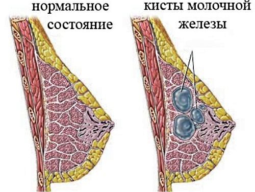 Болят грудные железы. Причины у женщин после/перед месячными, при климаксе, беременности. Лечение