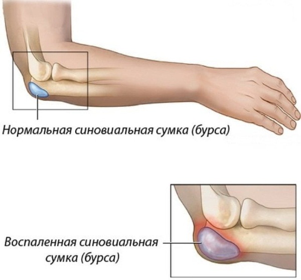Бурсит локтевого сустава. Фото, симптомы и лечение, народные средства, мази, препараты