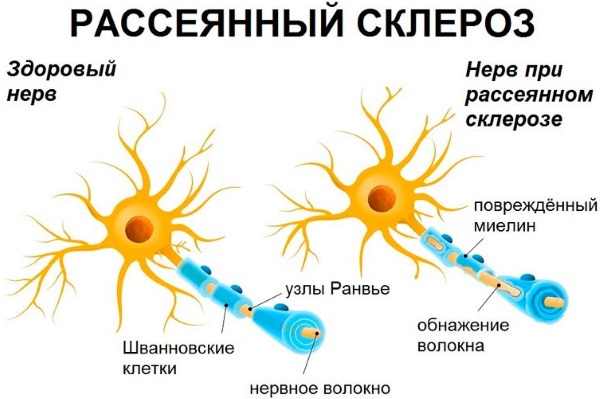 Дрожат руки. Причины тремора у молодых девушек, парней. Что делать, лечение