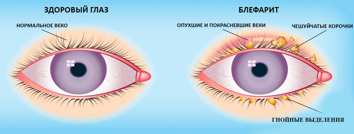 Флоксал мазь. Инструкция по применению для детей. Цена, аналоги