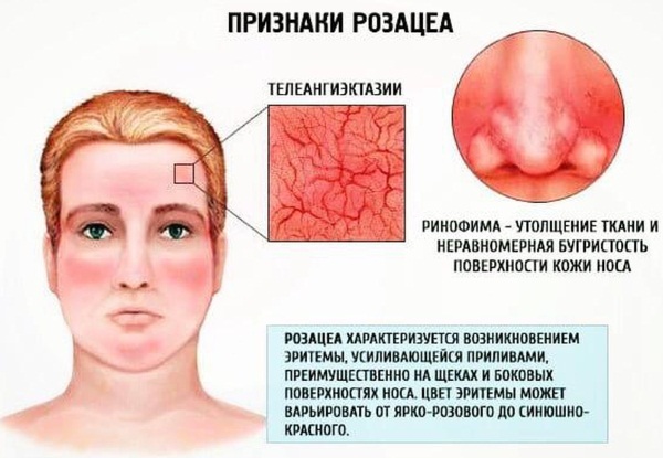 Фторокорт мазь. Инструкция по применению, цена, отзывы, аналоги