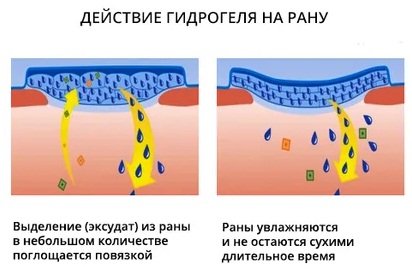 Гидрогелевые повязки от пролежней. Показание к применению, цены, где купить