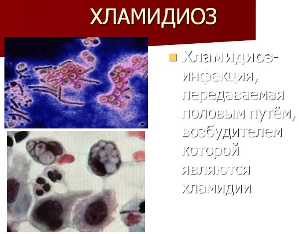 Хламидиоз у женщин. Симптомы и лечение при беременности. Препараты, народные средства