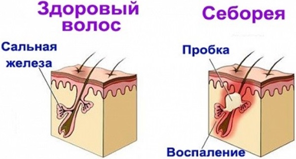 Как избавиться от себореи на голове у взрослых, ребёнка, грудничка