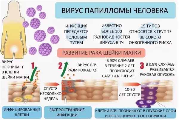 Кандилома у женщин. Фото, лечение вируса, симптомы, от чего появляются при беременности