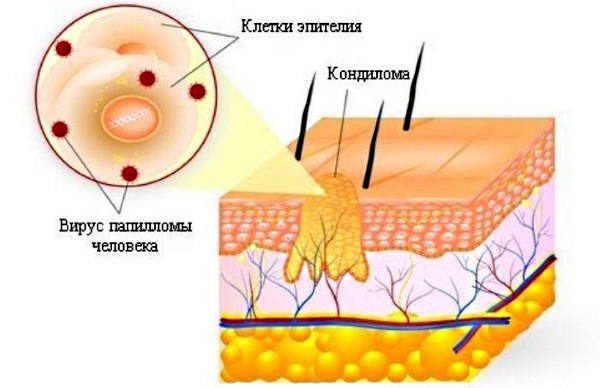 Кандилома у женщин. Фото, лечение вируса, симптомы, от чего появляются при беременности