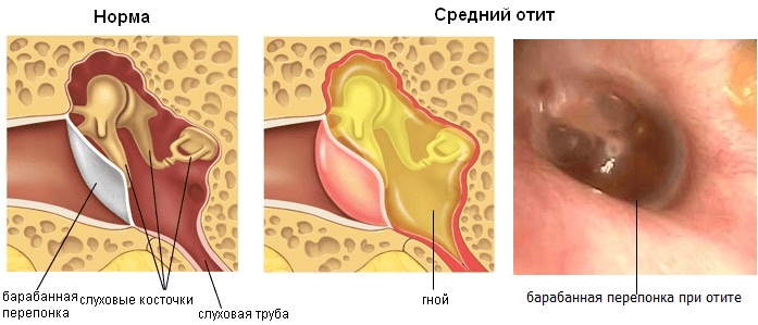 Противовоспалительные ушные капли для детей, взрослым. Недорогие с антибиотиком. Цены и отзывы