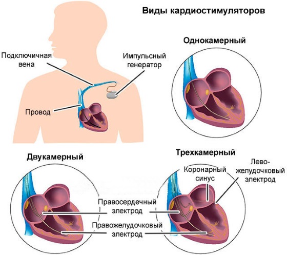 Кардиостимулятор. Что это такое, виды, как работает, сколько стоит, операция по установке, жизнь с ним