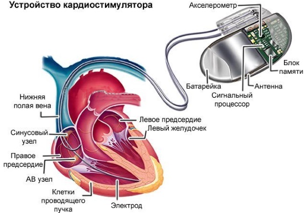 Кардиостимулятор. Что это такое, виды, как работает, сколько стоит, операция по установке, жизнь с ним