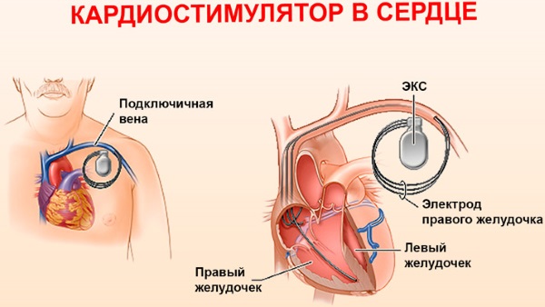 Кардиостимулятор. Что это такое, виды, как работает, сколько стоит, операция по установке, жизнь с ним