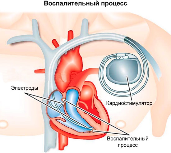 Кардиостимулятор. Что это такое, виды, как работает, сколько стоит, операция по установке, жизнь с ним