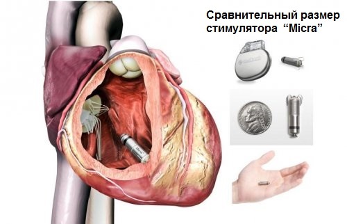 Кардиостимулятор. Что это такое, виды, как работает, сколько стоит, операция по установке, жизнь с ним