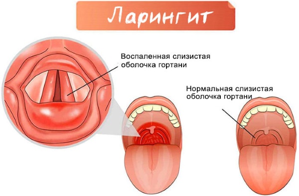 Лекарства от ларингита у взрослых. Препараты, спрей, антибиотики, народные средства