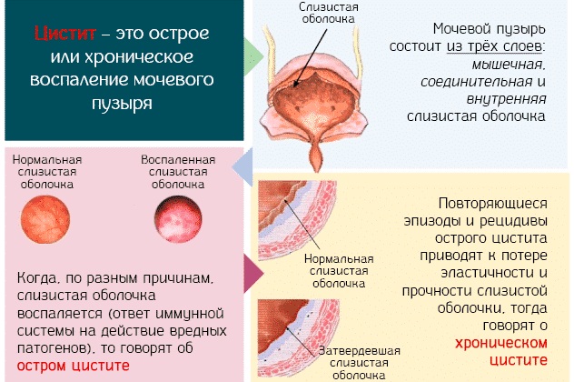 Моча по Нечипоренко. Норма у взрослых, детей лейкоцитов/эритроцитов, как сдавать, расшифровка