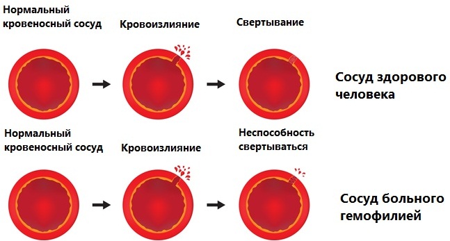 Моча по Нечипоренко. Норма у взрослых, детей лейкоцитов/эритроцитов, как сдавать, расшифровка