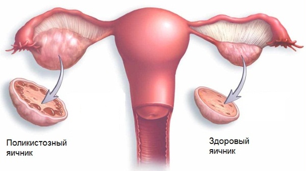 Нарушения менструационного цикла: классификация, причины и лечение