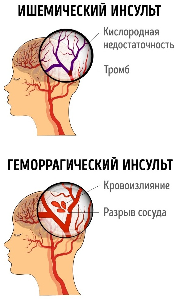 Назогастральный зонд. Алгоритм постановки детям, взрослым, уход, осложнения