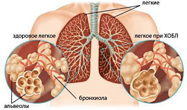 Обструктивный бронхит. Симптомы и лечение у взрослых, клинические рекомендации