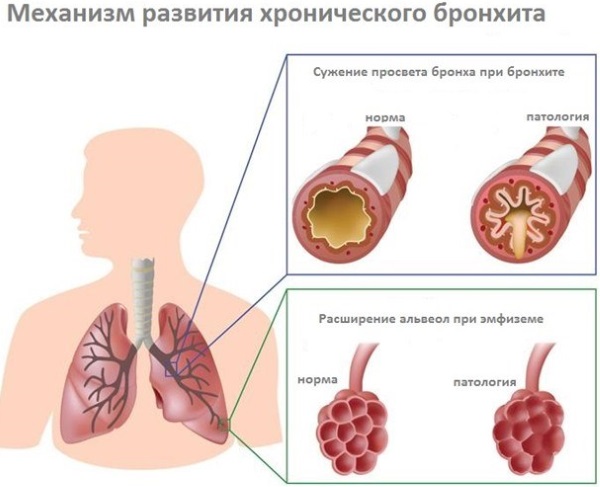 Обструктивный бронхит. Симптомы и лечение у взрослых, клинические рекомендации