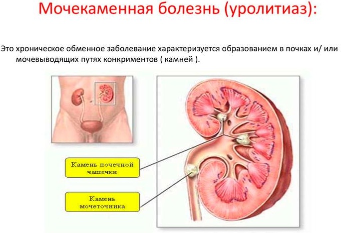 Опущение почек. Симптомы и лечение у женщин, мужчин, последствия и образ жизни