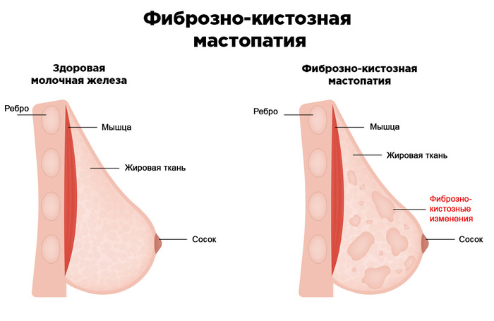 Перед месячными болит, грудные железы увеличиваются. Это нормально или нет, что делать