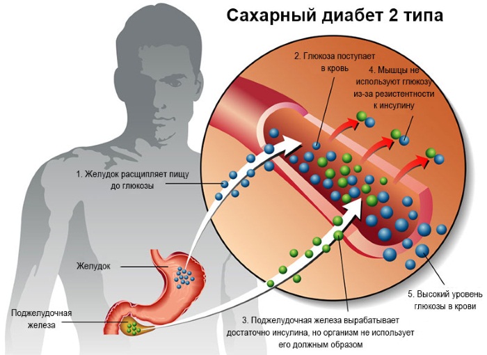 Повышенный инсулин в крови. Что это значит, если при нормальном сахаре. Лечение