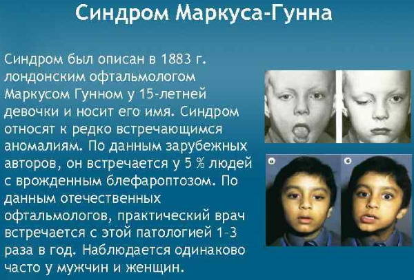 Птоз груди 3 степени фото