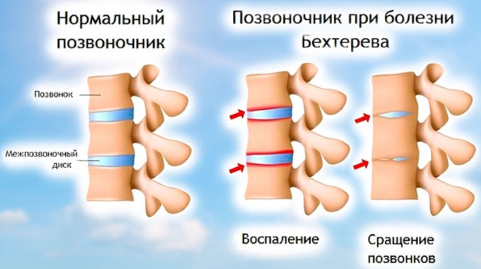 Боль в пятке при наступании, ломит. Причины и лечение, народные средства