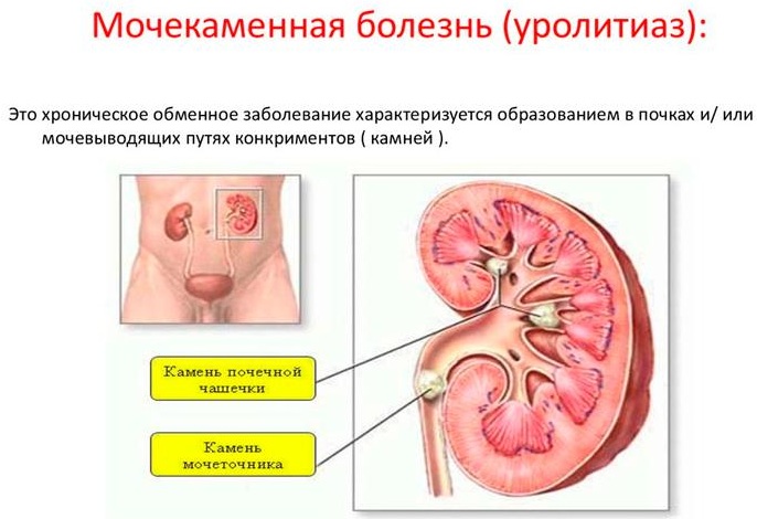 Боль в пятке при наступании, ломит. Причины и лечение, народные средства