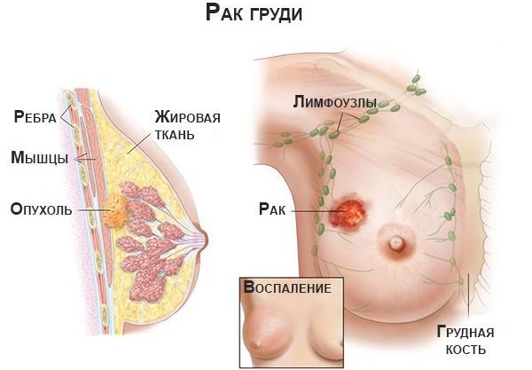 Шишка в подмышечной впадине у женщин болит. Как лечить, обследовать, к какому врачу обратиться