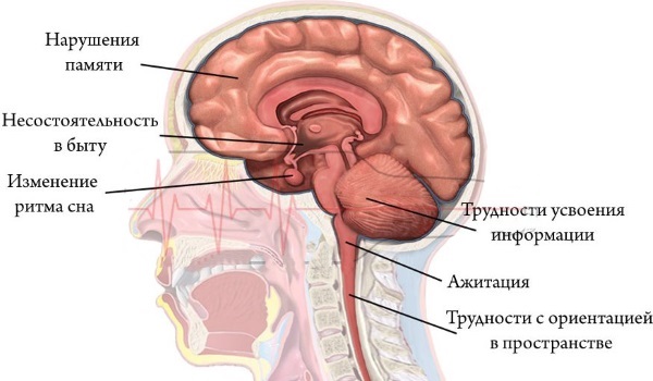 Старческое слабоумие. Симптомы и признаки у женщин, лечение деменции, препараты, уход