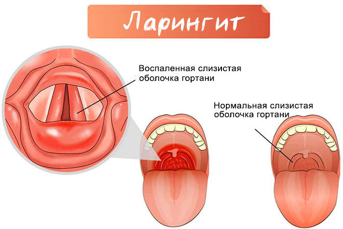 Тонзилгон для детей. Инструкция по применению (капли, таблетки). Цена, аналоги