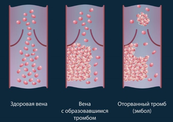 Тромбоз глубоких вен нижних конечностей. Симптомы, лечение народными средствами, препараты