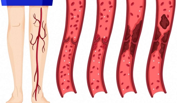 Тромбоз глубоких вен нижних конечностей. Симптомы, лечение народными средствами, препараты