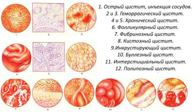 Цистит у женщин. Симптомы и лечение народными средствами, таблетки, антибиотики