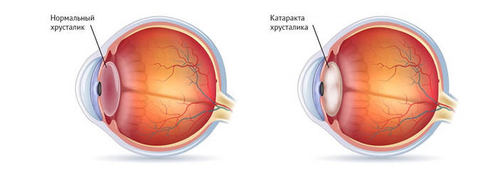Удаление катаракты в пожилом возрасте. Последствия, послеоперационный период, противопоказания