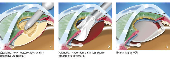 Удаление катаракты в пожилом возрасте. Последствия, послеоперационный период, противопоказания