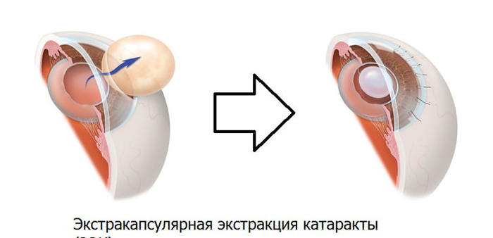 Удаление катаракты в пожилом возрасте. Последствия, послеоперационный период, противопоказания