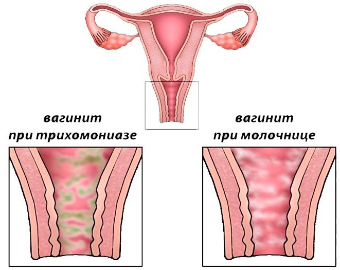 Бактериальный вагинит. Симптомы и лечение хронический, подострый, свечи при беременности