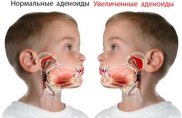 Заложенность носа без насморка. Причины и лечение, народные средства, капли