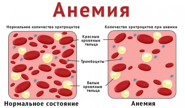 Желтая моча. Причины у женщин ярко-, темно-желтая при беременности, с запахом, белыми хлопьями. Что это может быть