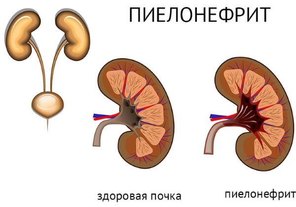 Желтая моча. Причины у женщин ярко-, темно-желтая при беременности, с запахом, белыми хлопьями. Что это может быть