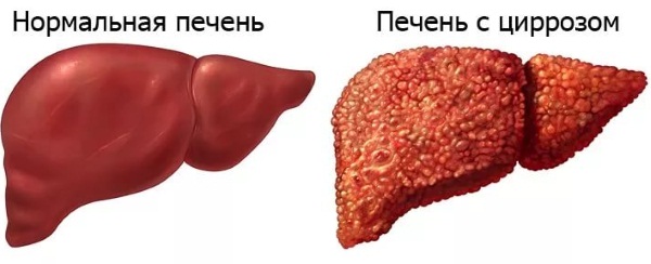 АЛТ в Анализе Крови Повышен: Вызывают 3 Заболевания и 6 Причин