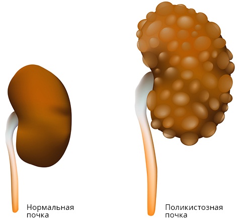 Болезни почек. Симптомы и признаки у женщин, температура, задержка, диагностика