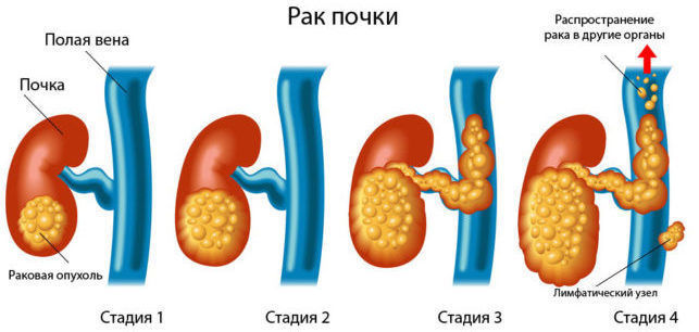 Болезни почек. Симптомы и признаки у женщин, температура, задержка, диагностика