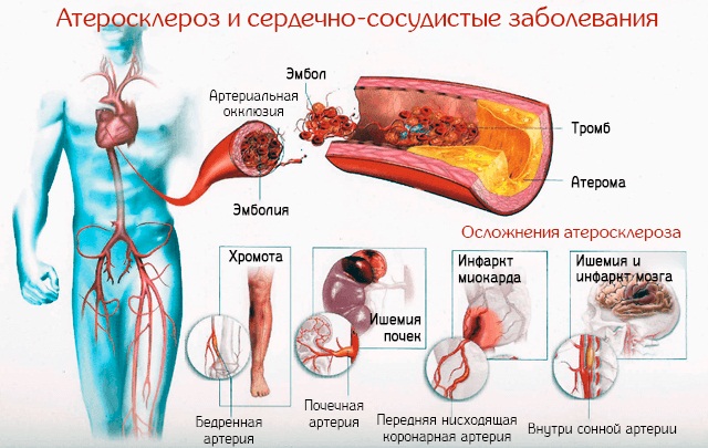 Чистка сосудов народными средствами у взрослых, освобождение их от холестерина. Лучшие рецепты, лимон, чеснок и мёд