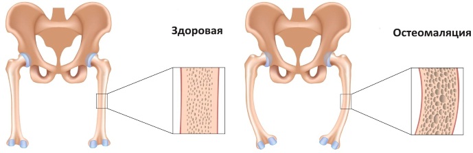 Фосфатаза щелочная в анализе крови. Что это такое, что значит повышена, что делать