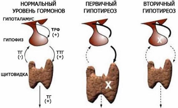 Гипотиреоз фото до и после